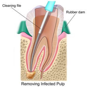 root_canal Cosmetic Dentist in Oklahoma City